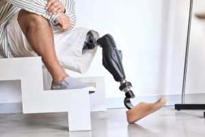 Man,Amputee,With,Prosthetic,Leg,Disability,On,Above,Knee,Transfemoral